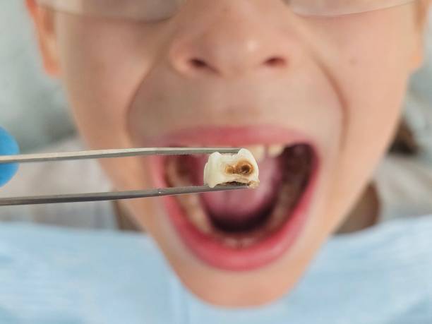 Best Dentist for Tooth Abscess  in Suamico, WI